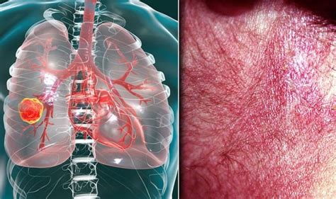 Lung Cancer Symptoms Signs Of Tumour Include Itchy Skin Rash Pain Express Co Uk