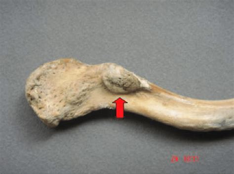 The Clavicular Facet Arrow Of The Coracoclavicular Joint As Seen On