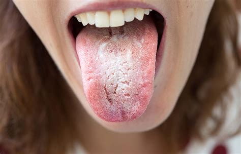 If You Have Bumps On Your Tongue Heres What They Could Mean