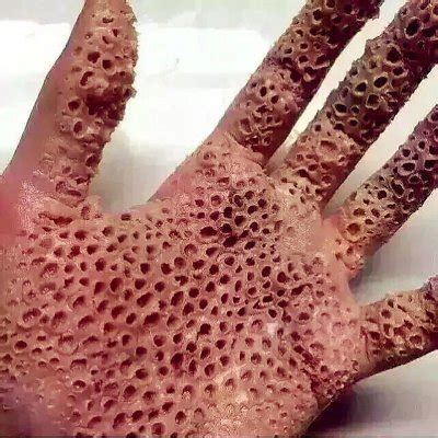 The Psychological Impact Of Hair Transplant Trypophobia Health Genz