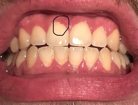 Cavity In Front Tooth Near Gumline Can This Be Fixed Raskdentists