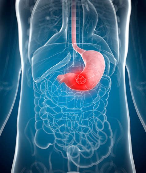 What Is Stomach Cancer