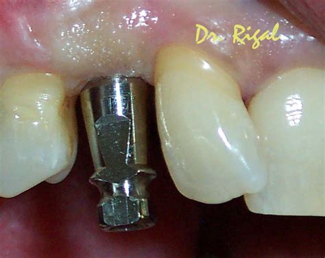 Implante Unitario Cirugia Virtual Implantes Dentales