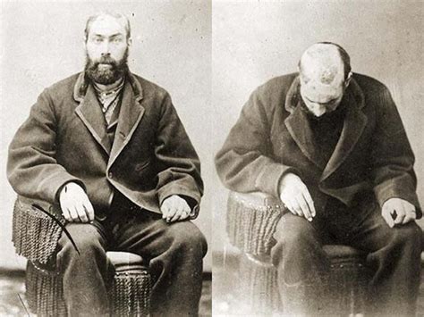 Robert Mcgee The Man Who Was Scalped As A Child By Native American
