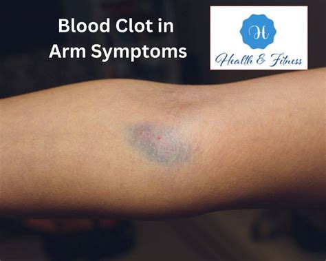 Blood Clot In Arm Symptoms What You Need To Know Now