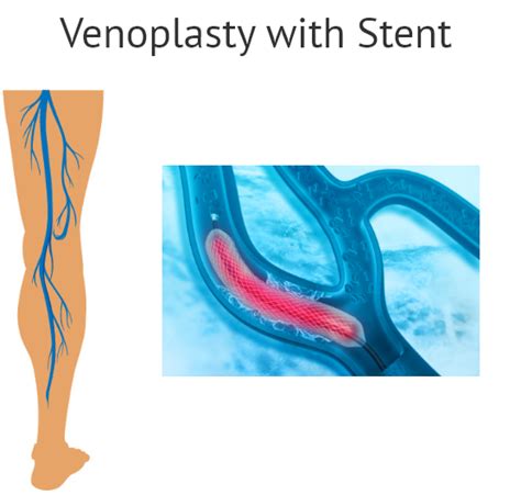 Venoplasty Vein Angioplasty And Stenting Elite Cardiovascular Group
