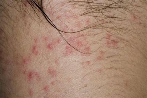 Bed Bug Allergic Reaction Bed Bug Get Rid