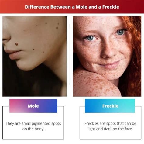 Mole Vs Freckle Difference And Comparison