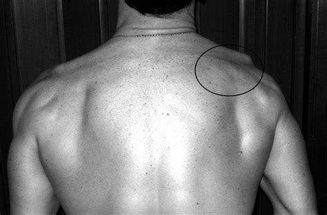 Scapular Dyskinesis And Sick Scapula Syndrome In Patients With Chronic