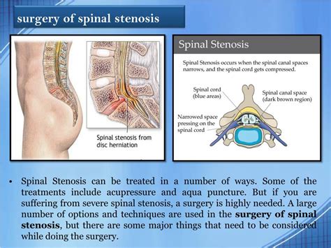 Ppt Surgery For Spinal Stenosis Powerpoint Presentation Free