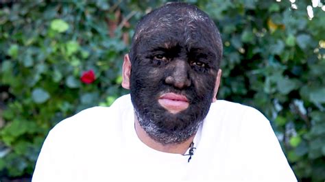 Worlds Hairiest Man Has Hair Covering 98 Percent Of His Body Inside