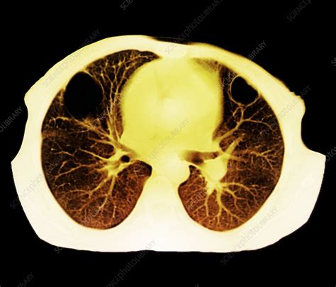 Lung Abscess Ct Scan Stock Image C0095379 Science Photo Library