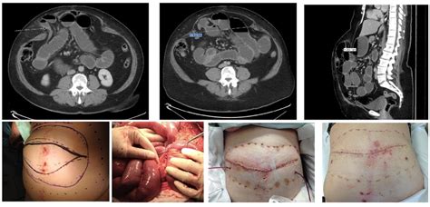 Massive Ventral Hernia Repair A Novel Technique With An Innovative Device
