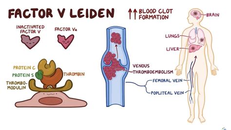 Factor V Leiden 🦁 And Protein Cs Deficiency 🐯 And Vte 🐻 Oh My In This