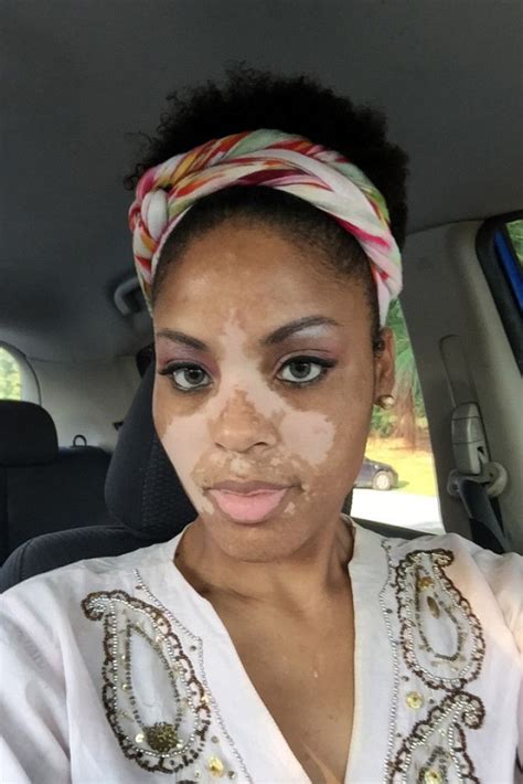Woman With Vitiligo Is Our Body Image Hero Vitiligo Treatment