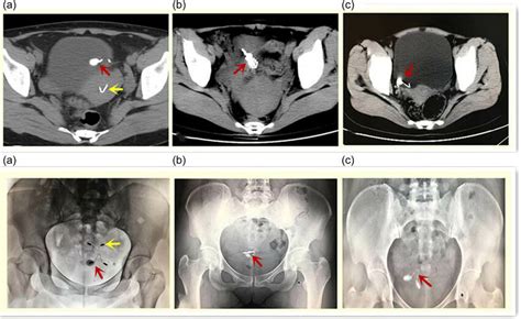 The Ectopic Iud Was Examined By Pelvic Radiography And Computed