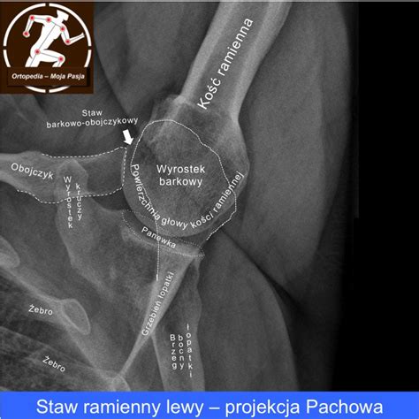Anatomia Rtg Barku Projekcja Pachowa Micha Drwi Ga Lekarz Ortopeda