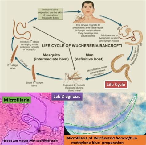 Filariasis Introduction Classification Life Cycle Clinical Features