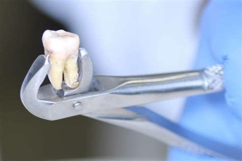 Tooth Extraction And The Aftercare Istanbul Dental Care