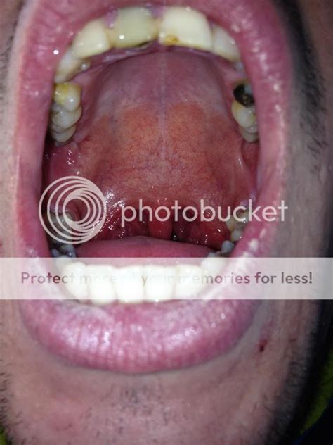 Mouth Ulcers On Back Of Throat