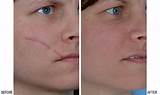 Laser Treatment To Remove Scars On Face Pictures