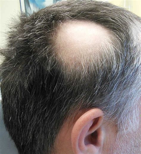 Alopecia Bald Spot Vlrengbr