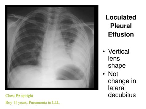Thoracentesis of loculated pleural effusions is facilitated … … in paramalignant pleural effusions, pleural fluid cytology and pleural biopsy are negative because… attempts at nonsurgical pleurodesis were partially successful or the effusion is significantly loculated. PPT - Pleural effusion in major fissure PowerPoint Presentation - ID:5306704