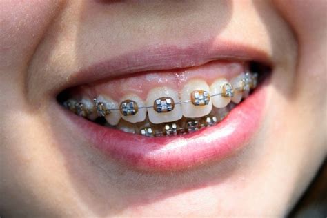 What Is Overbite How Do You Correct It Braces Or Surgery