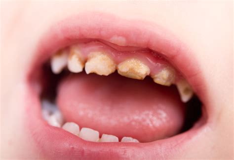 Tooth Decay In Children Has Nhs Dentistry Been Failing Us