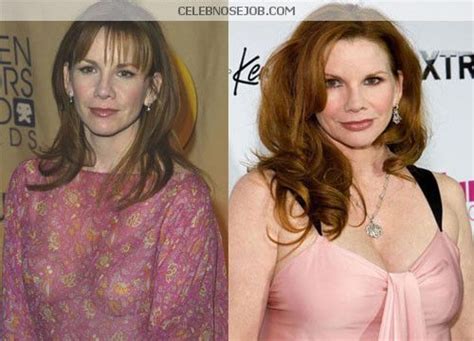 Melissa Gilbert Plastic Surgery Before And After Photos Melissa