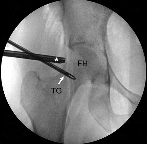 Lateral T Capsulotomy With Hip Arthroscopy For Access And Excision Of