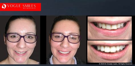 Dental Bonding And Composite Veneers Vogue Smiles