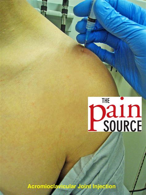 Acromioclavicular Joint Injection Technique And Tips The Pain
