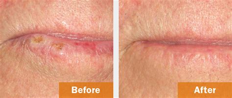 Before And After Henghold Skin Health And Surgery Group
