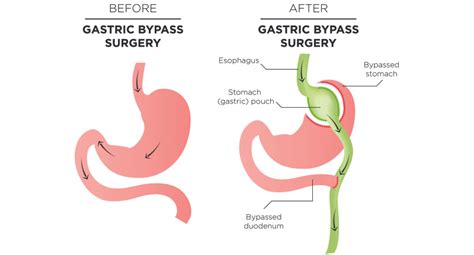 Gastric Bypass Surgery Melbourne How Stomach Bypass Works