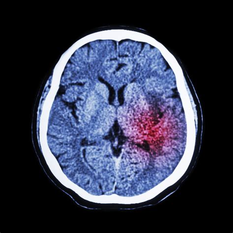 Gene Discovery Linked To Brain Disease Boosts Research On Strokes
