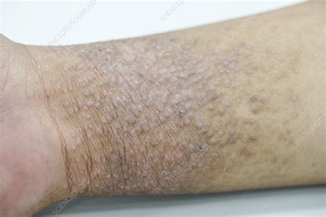 Eczema Stock Image F0324068 Science Photo Library