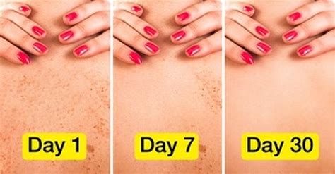 16 Natural Remedies To Get Rid Of Sunspots With Natural Remedies