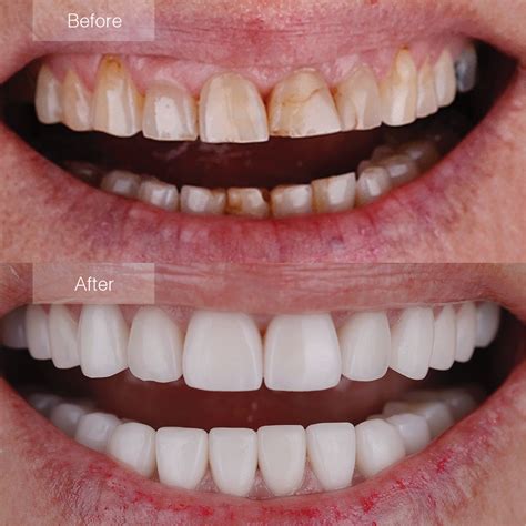 Porcelain Veneers Before And After The Dental Room