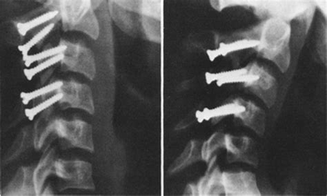 Surgical Stabilization Of Traumatic Cervical Spine Dislocation Using