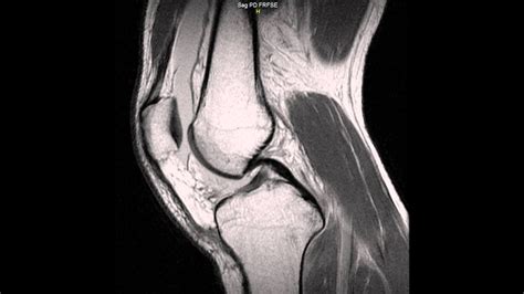 MRI On My Left Knee Possible Torn Meniscus Doctors P Doovi
