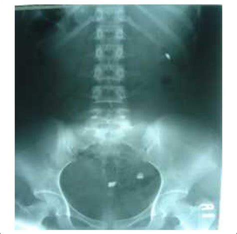 Kub Kidney Stone Photo