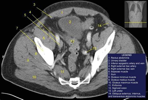 for detailed anatomy of pelvic bones, read anatomy of hip bone. Image result for iliacus muscle ct scan | Ct scan, Scan, Anatomy