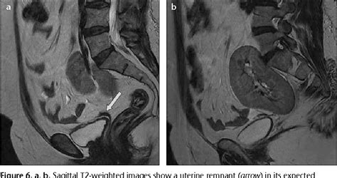 Figure 4 From Mri In The Diagnosis Of Mayer Rokitansky Kuster Hauser Syndrome Semantic Scholar