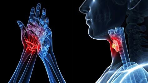 Rheumatoid Arthritis And Hashimotos Thyroiditis Whats The Connection