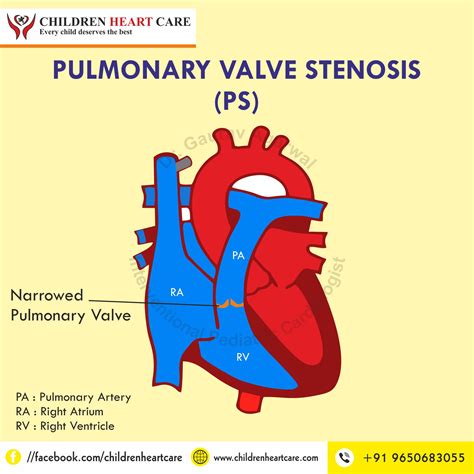 Pulmonary Stenosis Treatment In Delhi Dr Gaurav Agrawal
