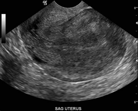 Retroverted Uterus Radiology Case Retroverted