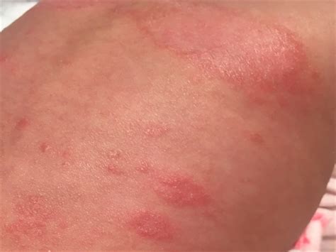 A Pruritic Rash Clinical Advisor