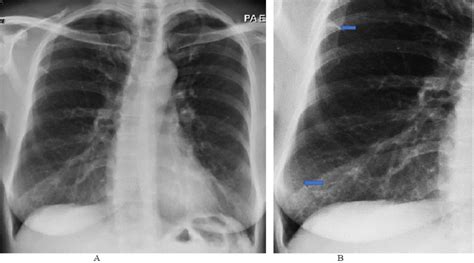 Plain X Ray Chest Showing Accentuated Hilar Shadows Increased Fine