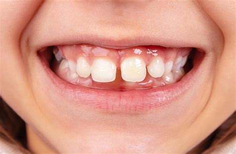 Treatment Options For Fixing A Gap Between Teeth Tompkins Dental